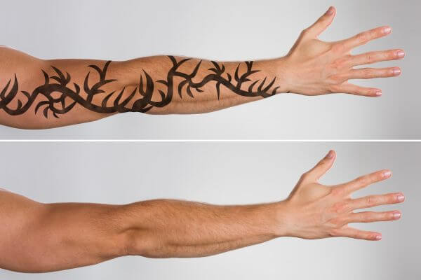 Tattooentfernung mit Laser – Hautarzt Augsburg